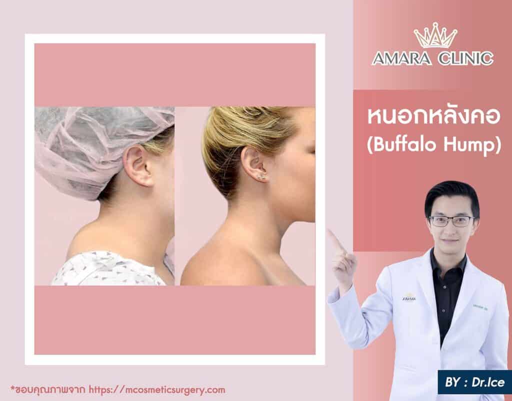 ดูดไขมันหนอกหลังคอ