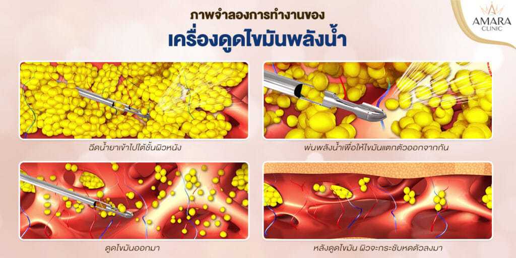 การทำงานของ Body-jet
