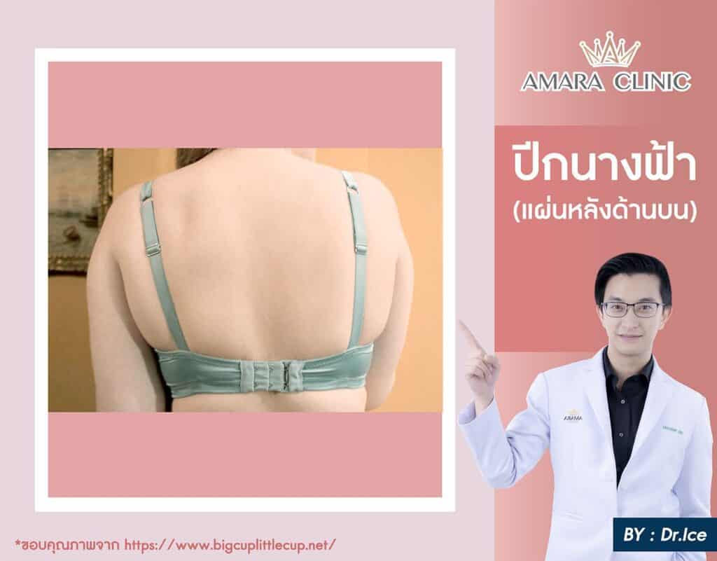 ดูดไขมันปีกนางฟ้า