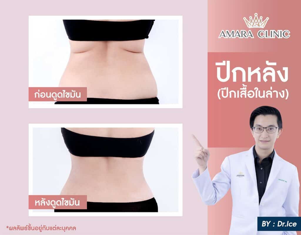 ดูดไขมันปีกหลัง
