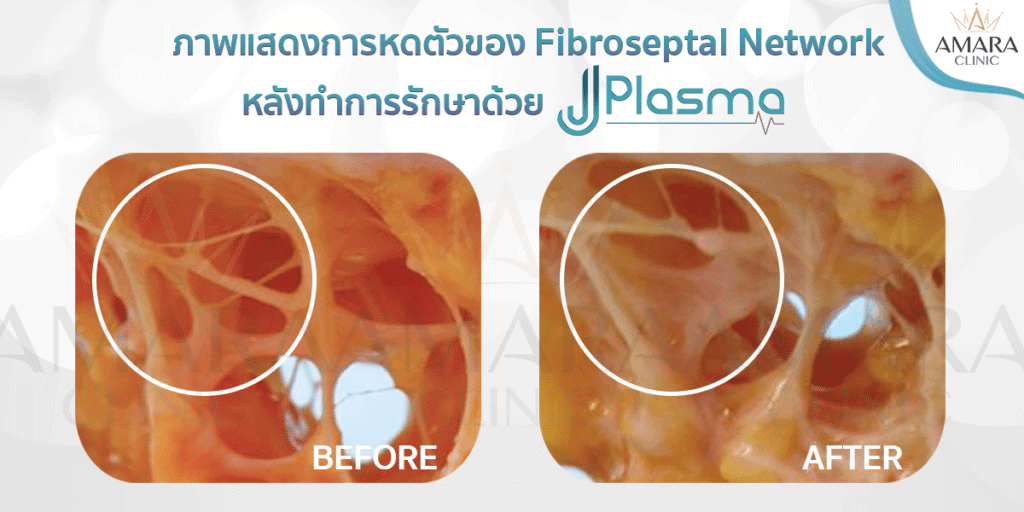 การทำงานของ J Plasma