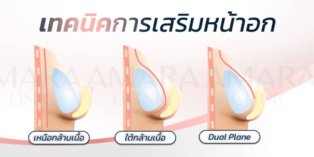 เทคนิคเสริมอก