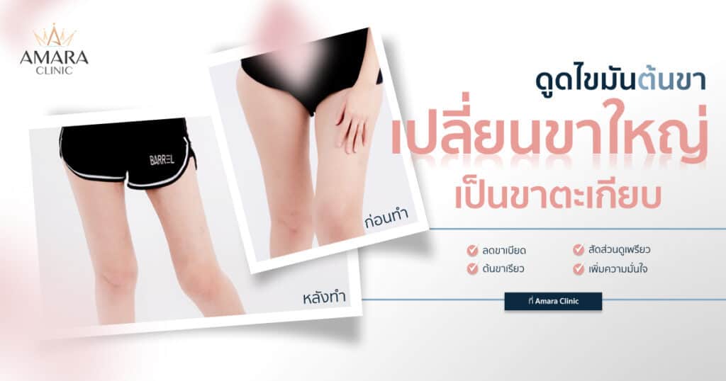 ดูดไขมันต้นขา