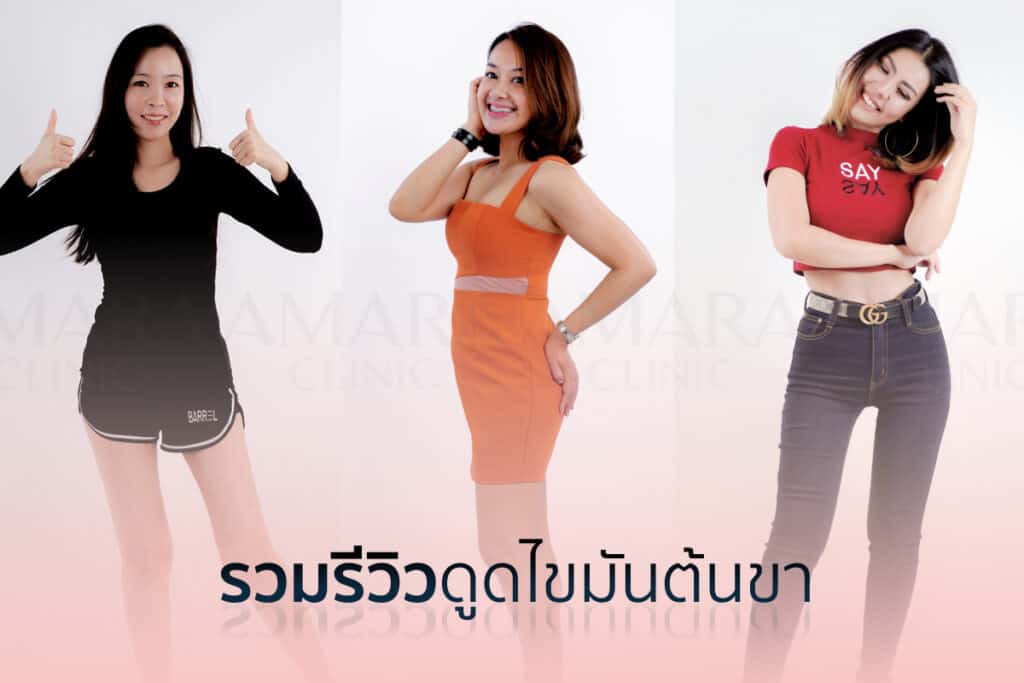 รีวิวดูดไขมันต้นขา