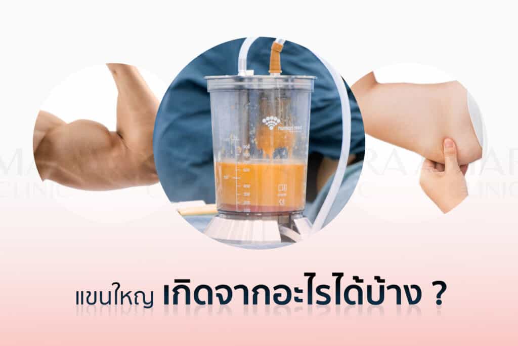 แขนใหญ่ เกิดจาก