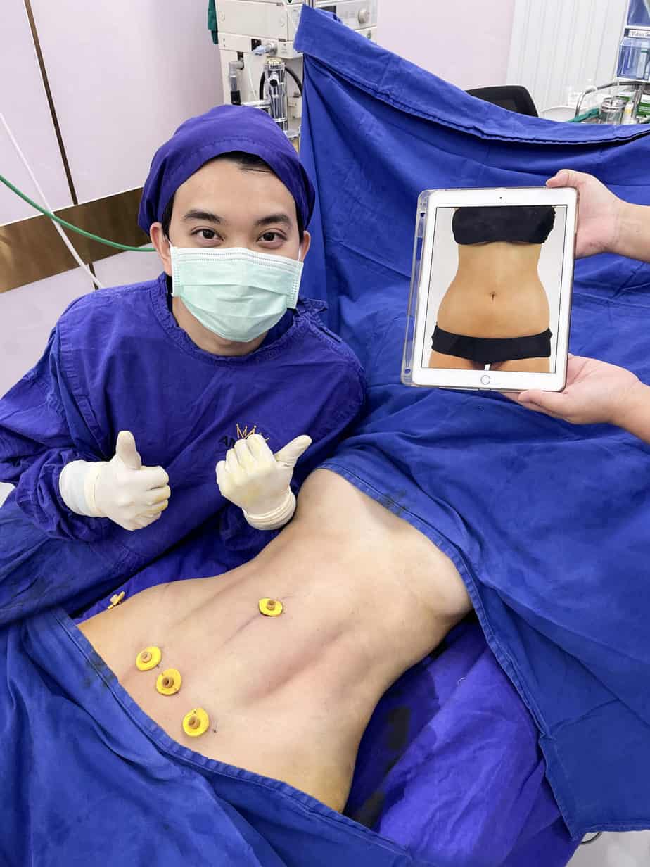 ดูดไขมันหน้าท้อง Sexy line