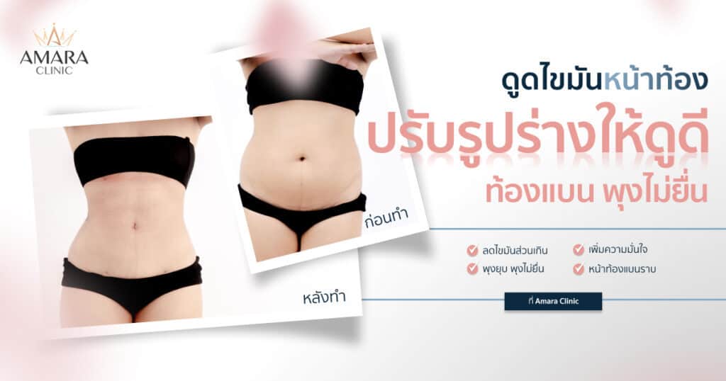 ดูดไขมันหน้าท้อง