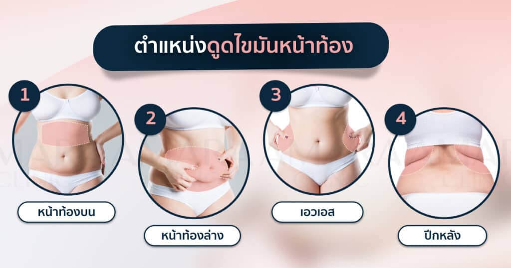 ตำแหน่งดูดไขมันหน้าท้อง