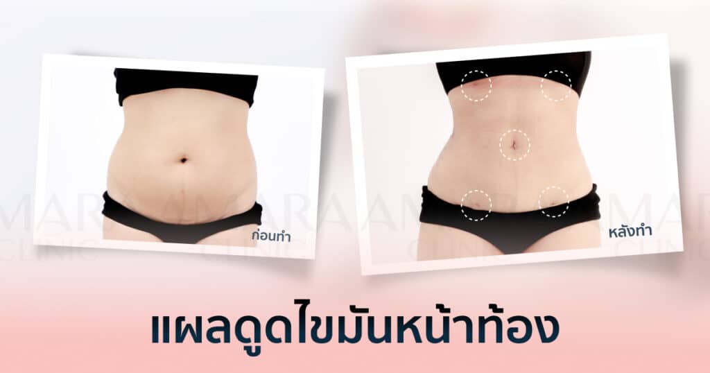 แผลดูดไขมันหน้าท้อง
