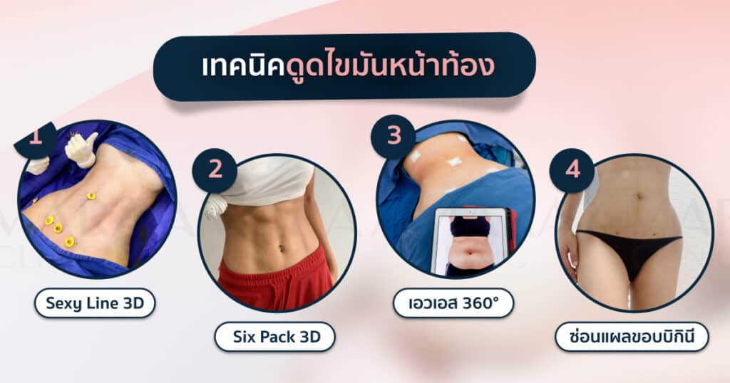 เทคนิคดูดไขมันหน้าท้อง