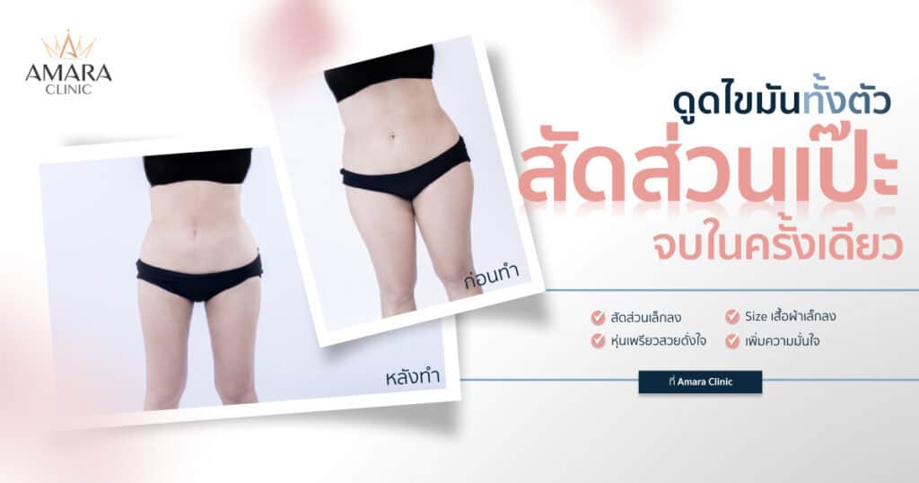 ดูดไขมันหน้าท้อง ราคา