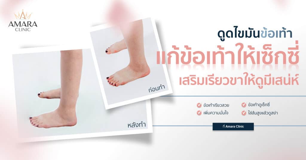 รีวิวดูดไขมันข้อเท้า