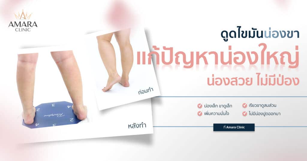รีวิวดูดไขมันน่อง