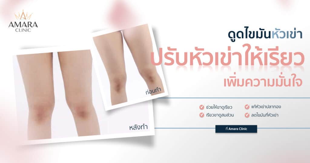 รีวิวดูดไขมันหัวเข่า