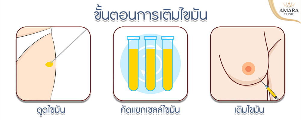 แผลทำนม
